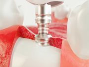 Костная пластика при имплантации зубов: виды