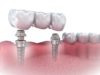 Как выглядит зубной мост из металлокерамики?