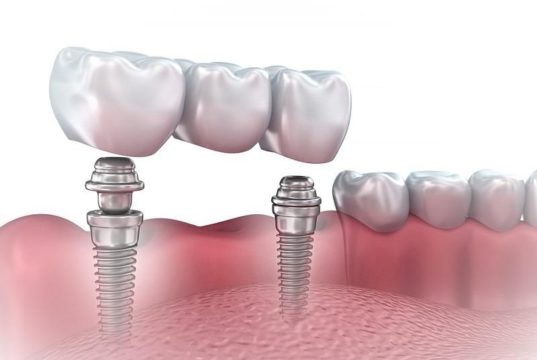Как выглядит зубной мост из металлокерамики?