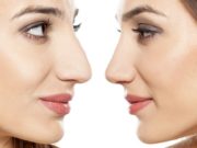 Когда и зачем делают ринопластику?