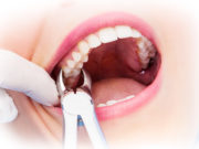 Возможные осложнения после удаления зубов