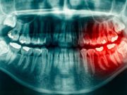 Рентген зуба: показания и особенности диагностики
