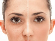 Как избавиться от пигментных пятен после акне