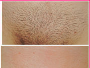 Шугаринг: до и после