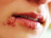 Герпес: причины, симптомы, и лечение вируса