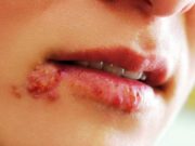 Герпес: причины, симптомы, и лечение вируса