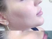 Особенности проведения контурной пластики подбородка