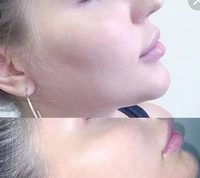 Особенности проведения контурной пластики подбородка