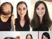 Особенности и преимущества системы замещения волос