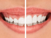 Особенности и специфика пластики десны