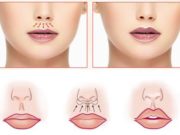 Хейлопластики губ: главные особенности