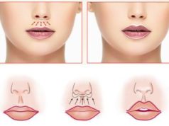 Хейлопластики губ: главные особенности