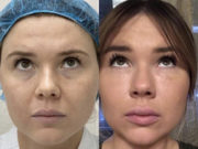 Блефаропластика: идеальное решение для роскошного взгляда