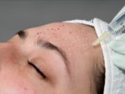 Что такое мезотерапия?