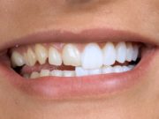 Установка виниров на передние зубы: оптимальный способ эстетической коррекции зоны улыбки