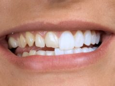 Установка виниров на передние зубы: оптимальный способ эстетической коррекции зоны улыбки