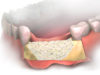 Костная пластика при имплантации зубов
