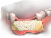 Костная пластика при имплантации зубов