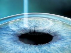 Лазерная коррекция зрения Smile