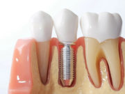 Одноэтапная имплантация зубов: установка импланта и протеза за один день