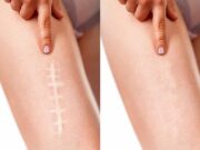 Коррекция рубцовой ткани: как избавиться от следов на коже и вернуть уверенность