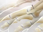 Остеотомия Вейля: что это за операция и кому она нужна