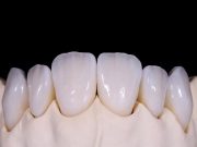 Коронки без страха: как выбрать между диоксидом циркония и E-Max керамикой