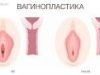 Вагинопластика: восстановление и коррекция женского здоровья