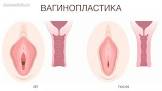 Вагинопластика: восстановление и коррекция женского здоровья